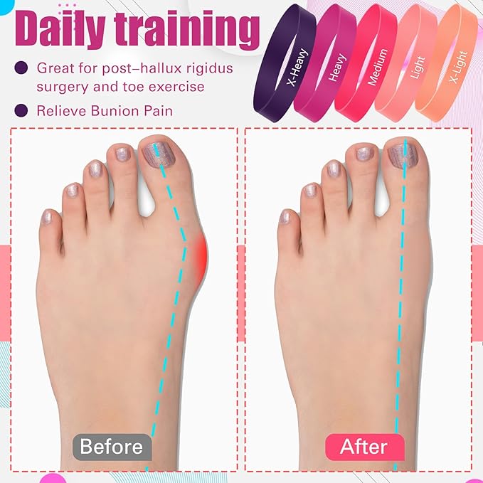 Set of 5 Toe Stretcher Band Separator Spacer Bunion Correction Hallux Valgus Alignment Foot Stretcher Straightener Resistance Loop Yoga Exercise Foot Care with Carry Bag(Pink)