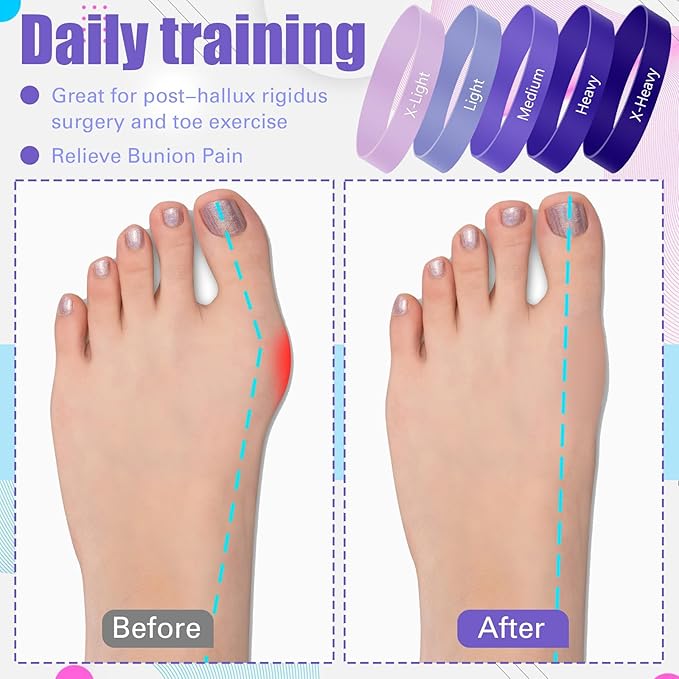Set of 5 Toe Stretcher Band Separator Spacer Bunion Correction Hallux Valgus Alignment Foot Stretcher Straightener Resistance Loop Yoga Exercise Foot Care with Carry Bag(Purple)